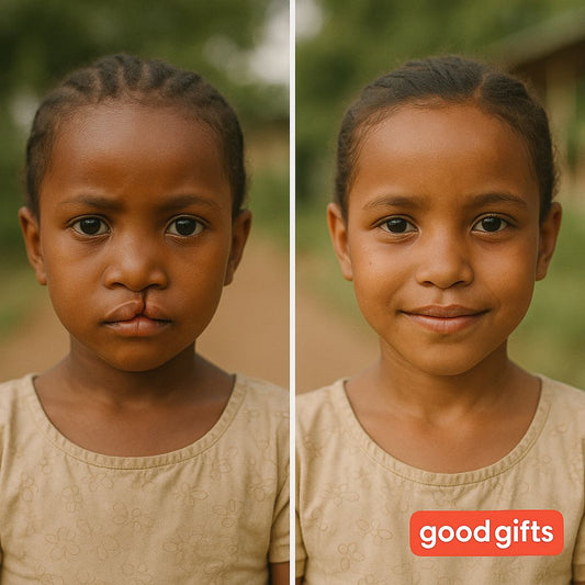 Cleft Lip Surgery